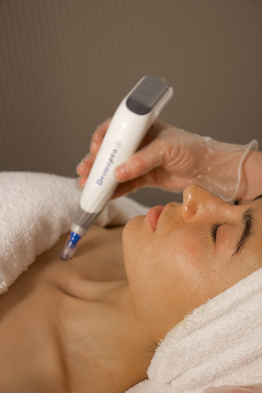 Microneedling